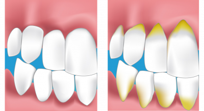 soins des gencives Beauchamp